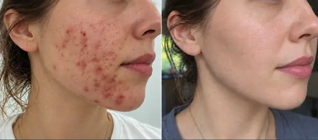 Illustrative comparison: clearer, calmer facial skin