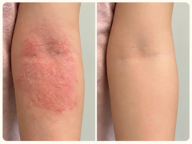 Illustrative comparison: calmed skin redness on the arm