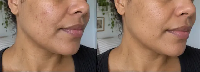 Illustrative comparison: smoother, more even facial skin