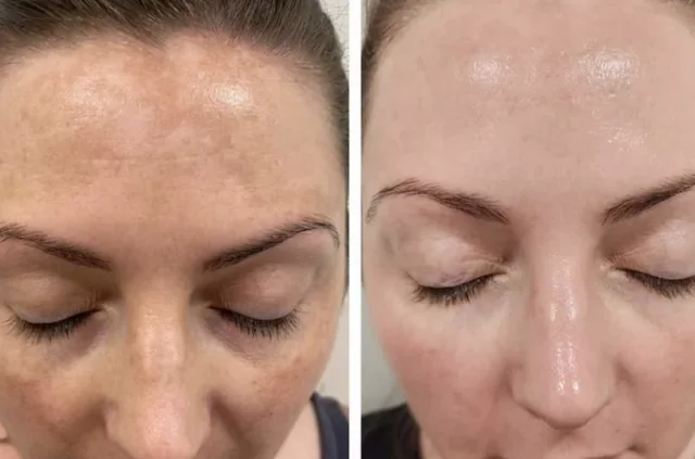 Illustrative comparison of forehead skin shown side by side